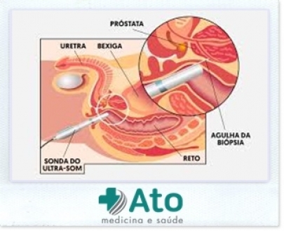 Biopsia de Prostata guiada por Ultrassonografia em Sao Paulo