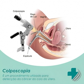 Colposcopia com ou sem Biopsia em São Paulo