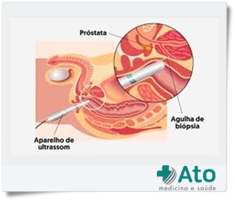 Biopsia-Prostata