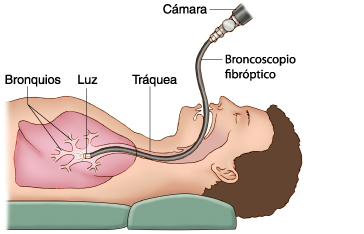 Broncoscopia-ato