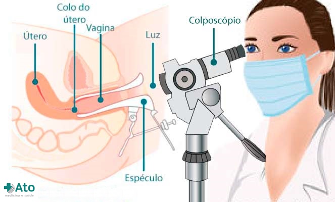 Colposcopia-ato